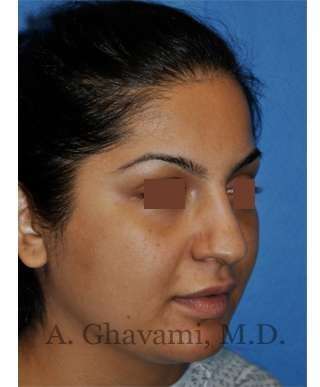 Ethnic Rhinoplasty Before & After Patient #7273