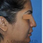 Ethnic Rhinoplasty Before & After Patient #7273
