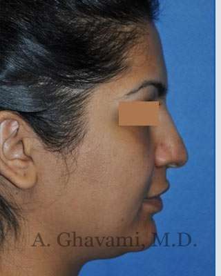 Ethnic Rhinoplasty Before & After Patient #7273