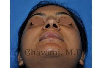 Ethnic Rhinoplasty Before & After Patient #7273