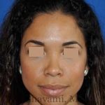 Ethnic Rhinoplasty Before & After Patient #7264