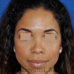 Ethnic Rhinoplasty Before & After Patient #7264
