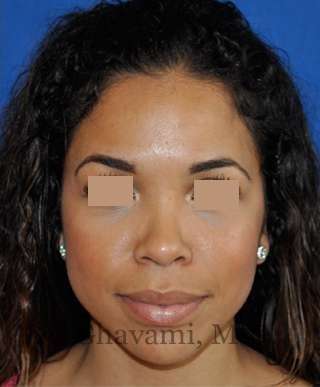 Ethnic Rhinoplasty Before & After Patient #7264