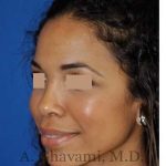 Ethnic Rhinoplasty Before & After Patient #7264