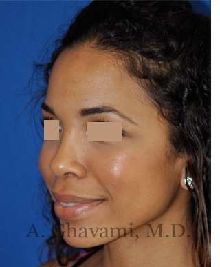 Ethnic Rhinoplasty Before & After Patient #7264