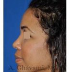 Ethnic Rhinoplasty Before & After Patient #7264