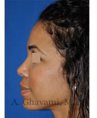 Ethnic Rhinoplasty Before & After Patient #7264