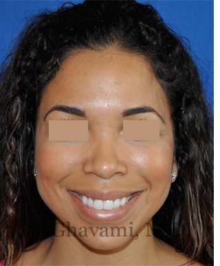Ethnic Rhinoplasty Before & After Patient #7264