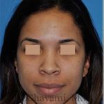 Ethnic Rhinoplasty Before & After Patient #7264