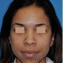 Ethnic Rhinoplasty Before & After Patient #7264