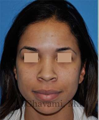 Ethnic Rhinoplasty Before & After Patient #7264