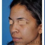 Ethnic Rhinoplasty Before & After Patient #7264