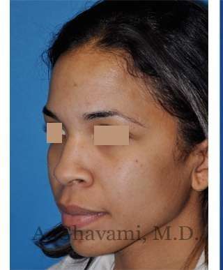 Ethnic Rhinoplasty Before & After Patient #7264