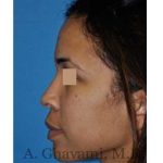 Ethnic Rhinoplasty Before & After Patient #7264