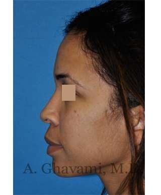 Ethnic Rhinoplasty Before & After Patient #7264