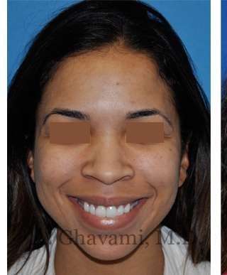 Ethnic Rhinoplasty Before & After Patient #7264
