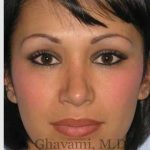Ethnic Rhinoplasty Before & After Patient #7248