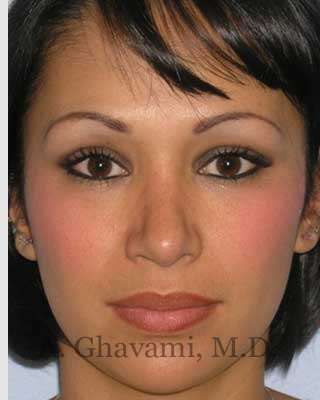 Ethnic Rhinoplasty Before & After Patient #7248