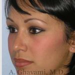 Ethnic Rhinoplasty Before & After Patient #7248