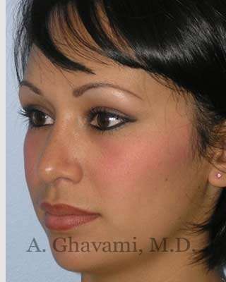 Ethnic Rhinoplasty Before & After Patient #7248