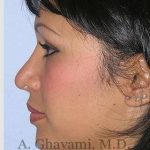 Ethnic Rhinoplasty Before & After Patient #7248