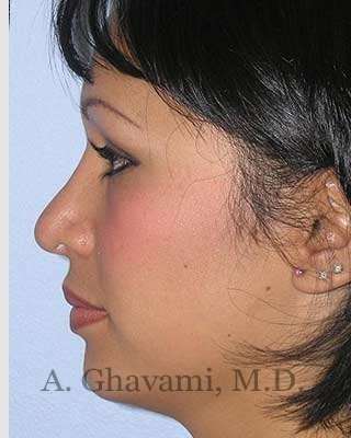 Ethnic Rhinoplasty Before & After Patient #7248