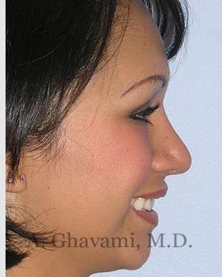 Ethnic Rhinoplasty Before & After Patient #7248