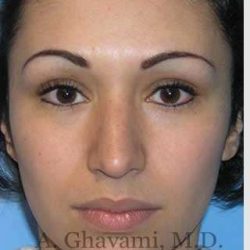 Ethnic Rhinoplasty Before & After Patient #7248