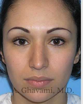 Ethnic Rhinoplasty Before & After Patient #7248