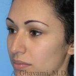 Ethnic Rhinoplasty Before & After Patient #7248