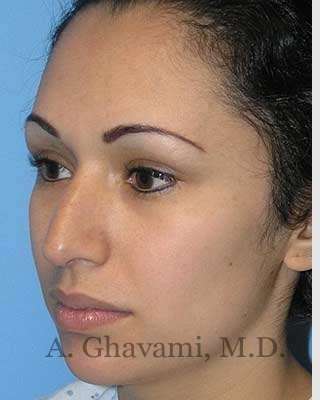 Ethnic Rhinoplasty Before & After Patient #7248