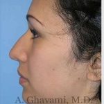 Ethnic Rhinoplasty Before & After Patient #7248