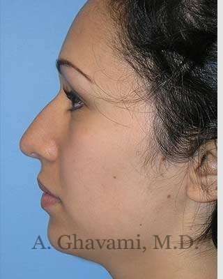 Ethnic Rhinoplasty Before & After Patient #7248