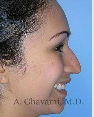 Ethnic Rhinoplasty Before & After Patient #7248
