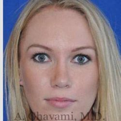 Rhinoplasty Before & After Patient #7239