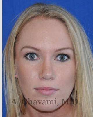 Rhinoplasty Before & After Patient #7239