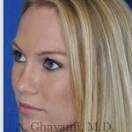 Rhinoplasty Before & After Patient #7239