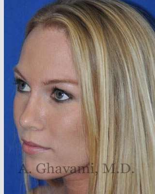 Rhinoplasty Before & After Patient #7239
