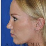 Rhinoplasty Before & After Patient #7239