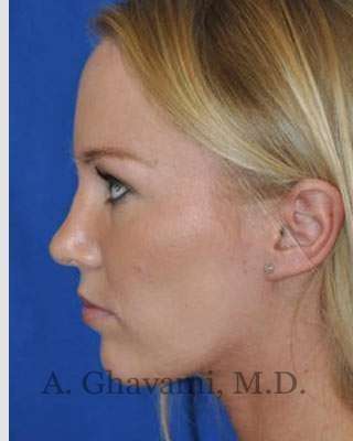 Rhinoplasty Before & After Patient #7239
