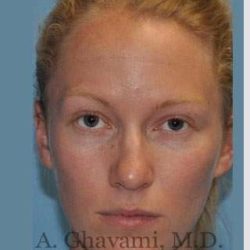 Rhinoplasty Before & After Patient #7239