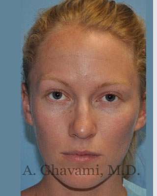 Rhinoplasty Before & After Patient #7239