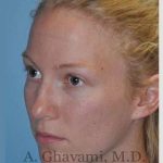 Rhinoplasty Before & After Patient #7239
