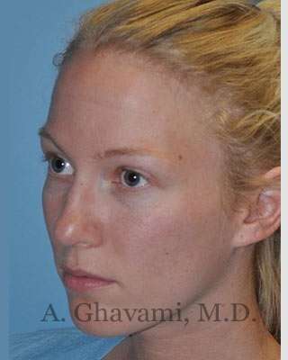 Rhinoplasty Before & After Patient #7239
