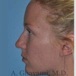 Rhinoplasty Before & After Patient #7239