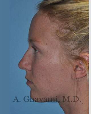 Rhinoplasty Before & After Patient #7239