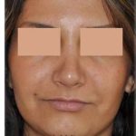 Rhinoplasty Before & After Patient #7232