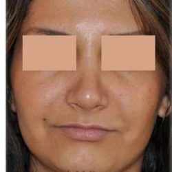 Rhinoplasty Before & After Patient #7232