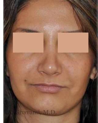 Rhinoplasty Before & After Patient #7232