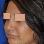 Rhinoplasty Before & After Patient #7232